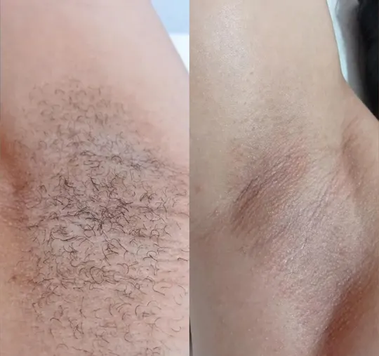 Axila antes e depois da depilação com cera: com pelos à esquerda, pele lisa à direita